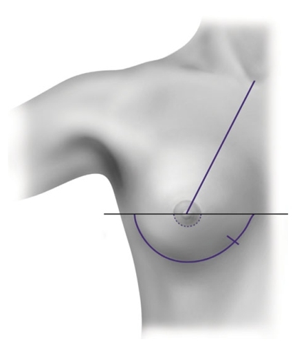 Что такое – перманентный макияж ареол? Разбираемся в особенностях процедуры.
