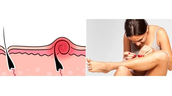 Как избавиться от врастающих волос на теле